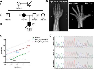 Case report: A novel heterozygous frameshift mutation of ACAN in a Chinese family with short stature and advanced bone age